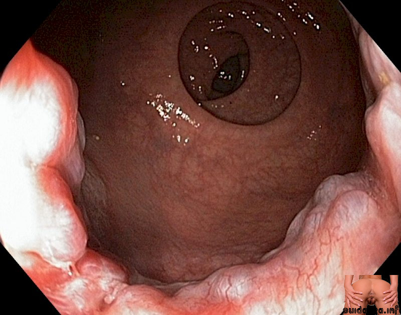 anatomy endoscopy internal human camera gastrolab
