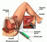 transrectal handjob milking prostate massage prostatectomy male therapy guided