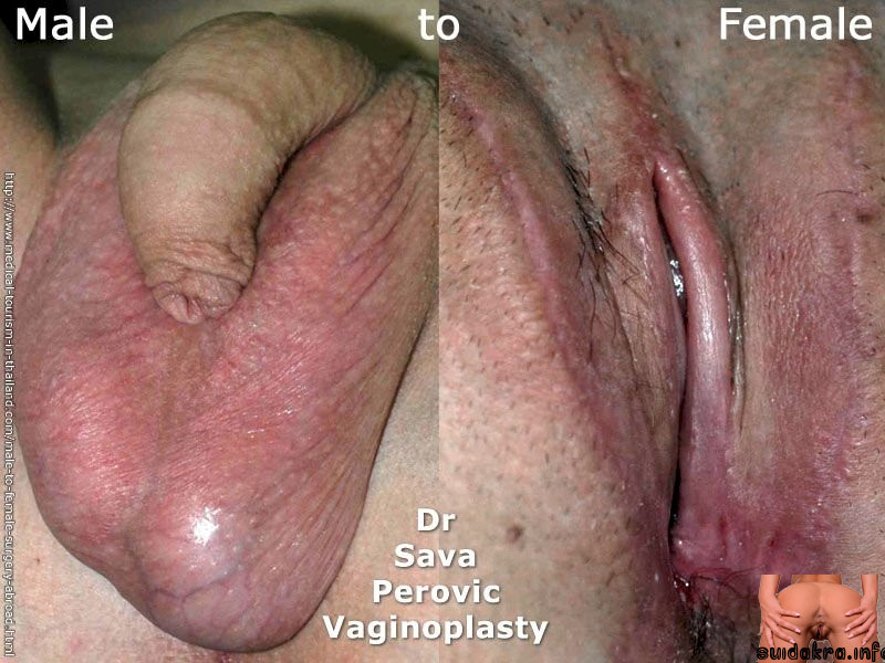 procedure penis surgery vagina results reassignment op srs male