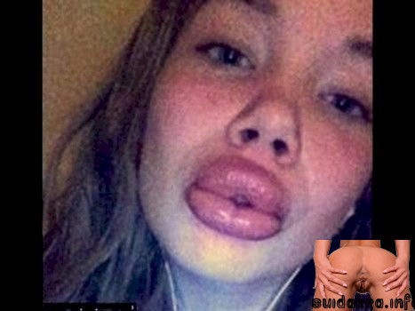 activity lips jenner deformity challenge