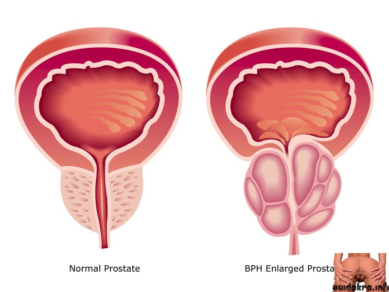 surgery prostate health