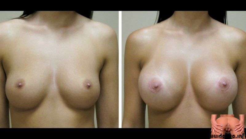 breast enhancement porn galleries implants breast