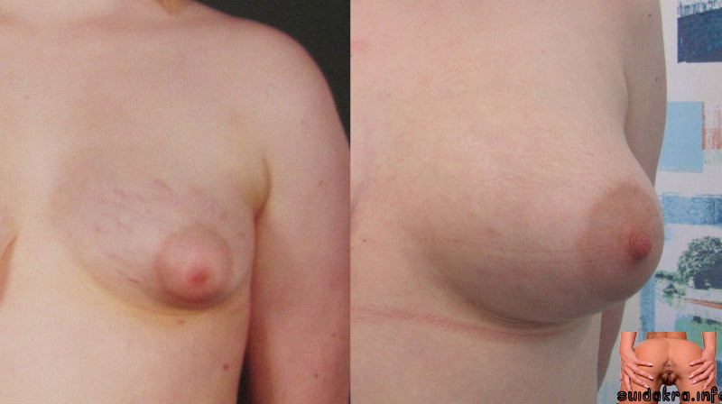 enhancement breast fat saline both tits before