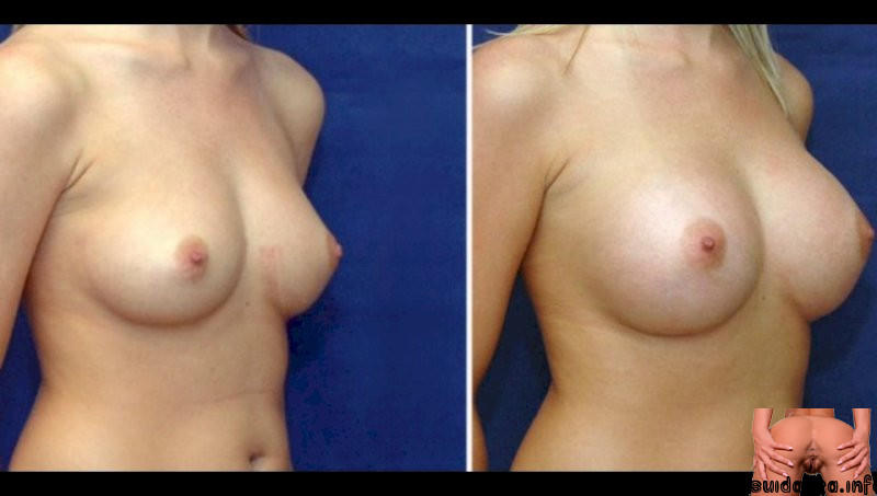 xvideos breast implants