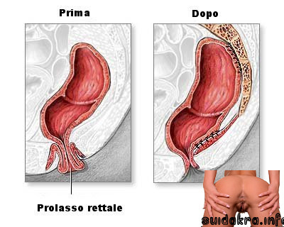 prolasso repair anale fisting wall rettale procedure prolapse
