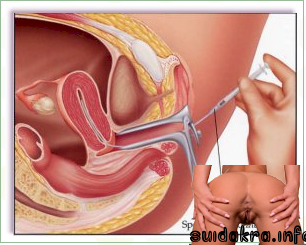 iui cervical sperm near mucus orgasm archives procedure treatment premature directly into washing catheter