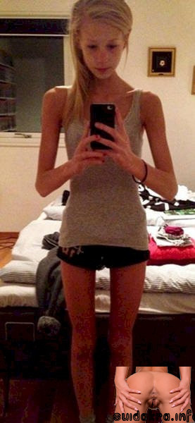 anorexic disease young had fights story given years anorexic girl shows pussy weight izismile