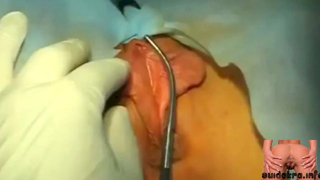cutting cut pussy getting labiaplasty bizarre anal cutting up pussy tube