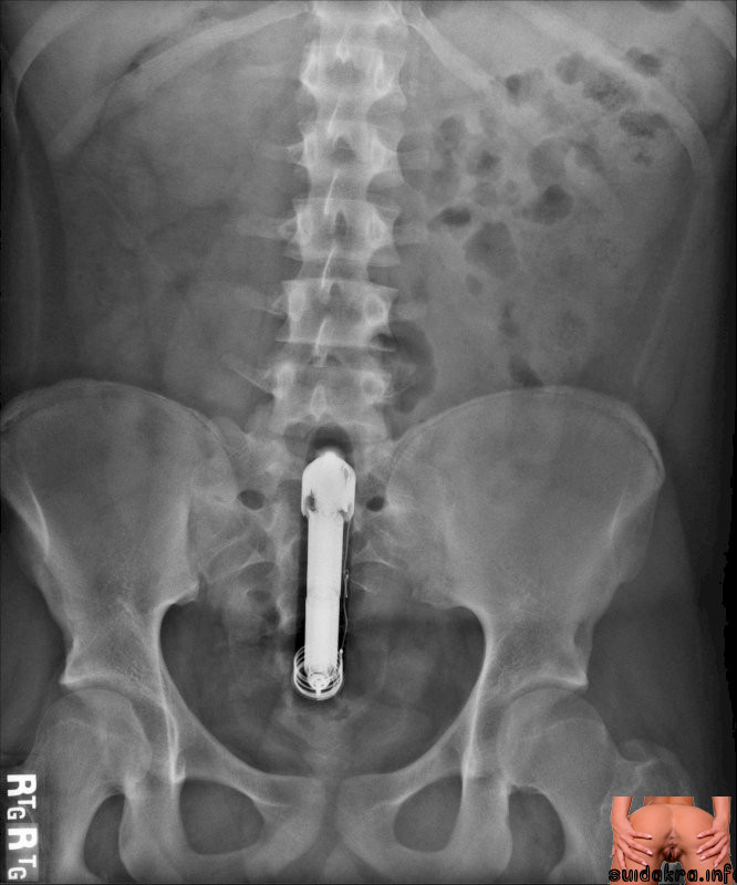 hospital guy toy dildo stuck but hole stuck he ass dildo